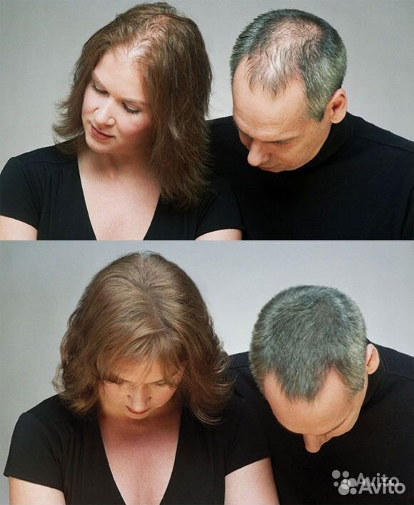 Восстановление волос на голове у мужчин