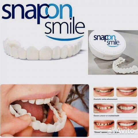 Виниры Snap-On Smile Виниры Snap-On Smile